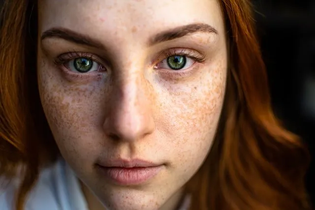 Freckles are natural pigmentation