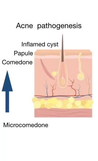 Acne Pathogenesis