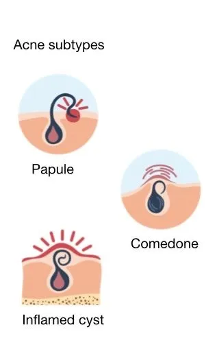 Acne Subtypes
