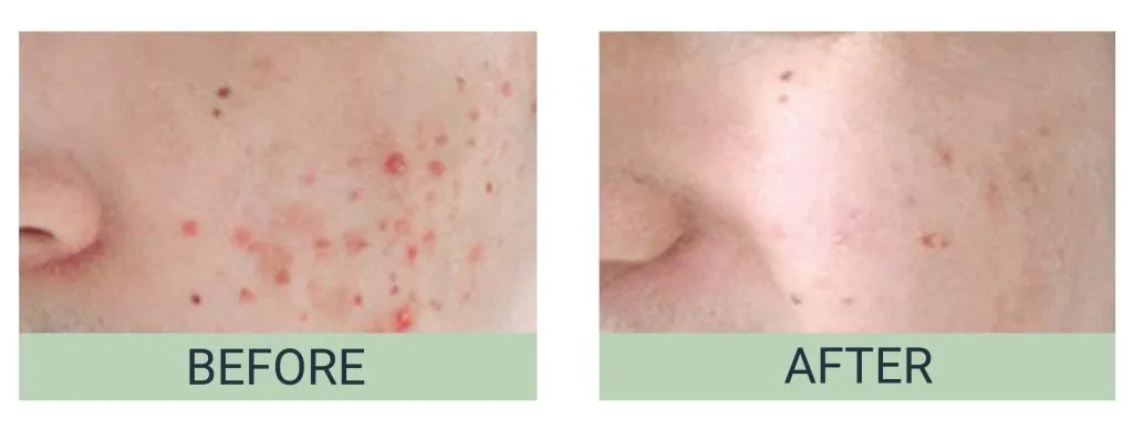 Eucerin Acne Skincare Routine Before / After